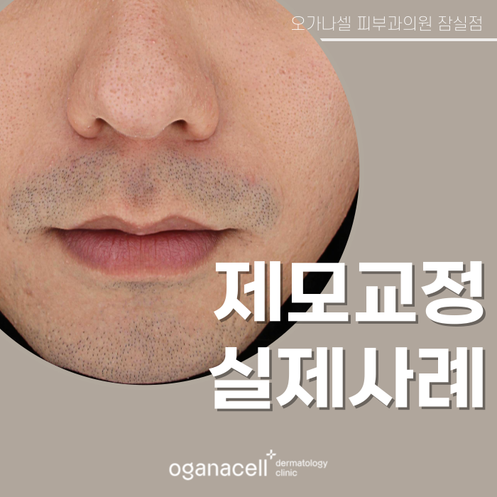 잠실역피부과 제모 남자수염 실제사례(+피부톤개선) 관련 이미지 1