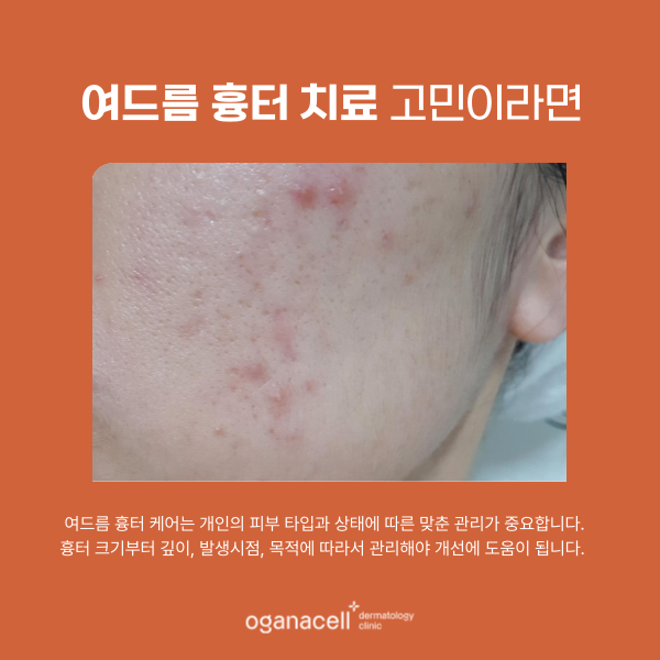 여드름 흉터 관리법 : 홈케어 및 잠실피부과 관리 관련 이미지 4