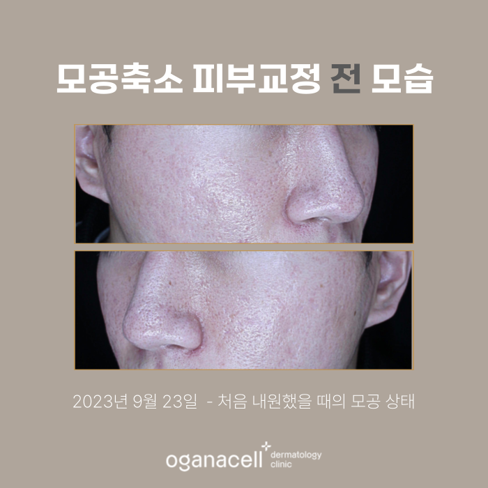 송파구모공피부과 관리 전후 실제사례 후기 관련 이미지 2