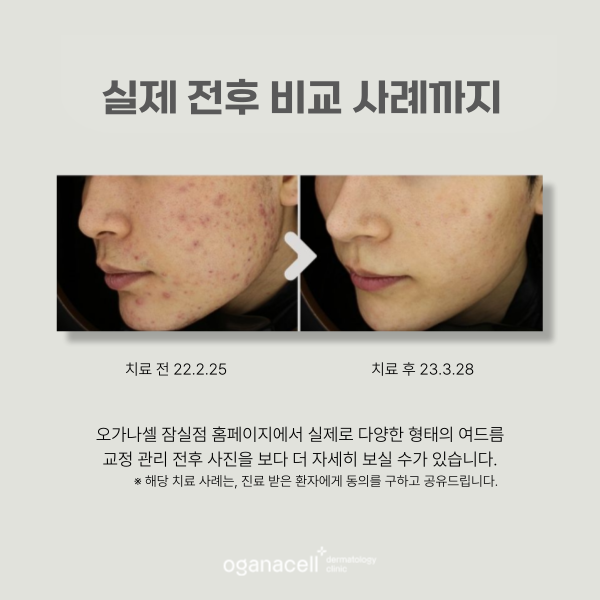 잠실여드름피부과 재발 가능성 낮추는 팁 관련 이미지 5
