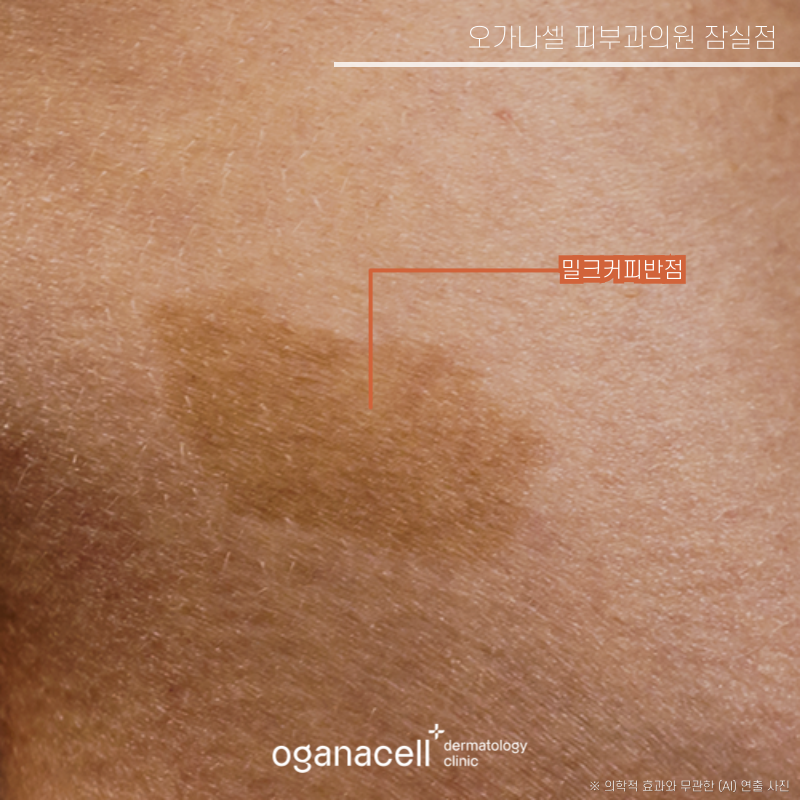 난치성 색소 치료 방법 밀크커피반점, 베커모반, 군집성흑자증, 오타모반 의심될 때 관련 이미지 2