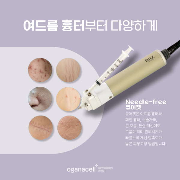 잠실여드름피부과 바늘없는 큐어젯 흉터 관리 방법 관련 이미지 5