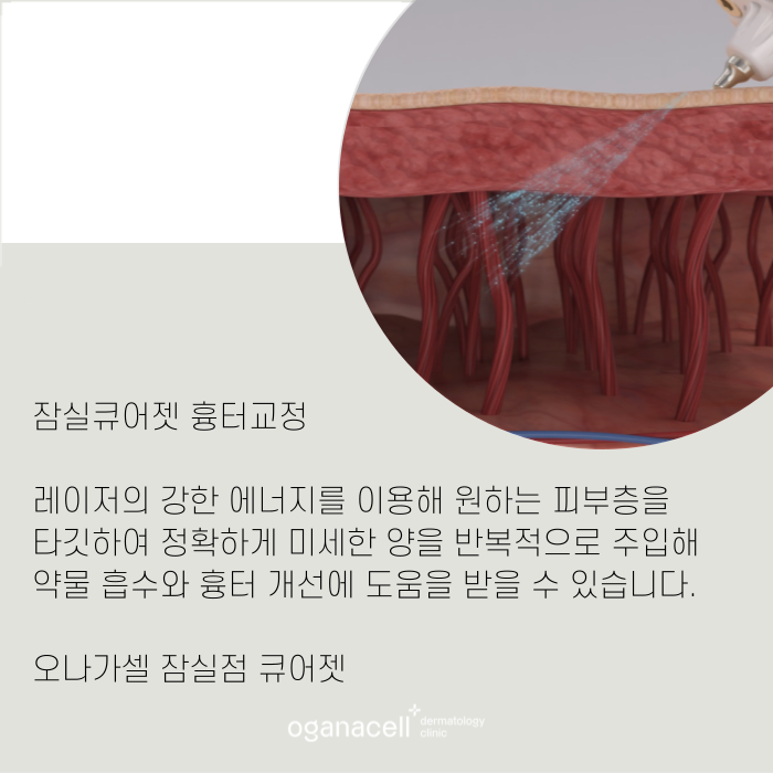 잠실큐어젯 흉터교정 방법 관련 이미지 8