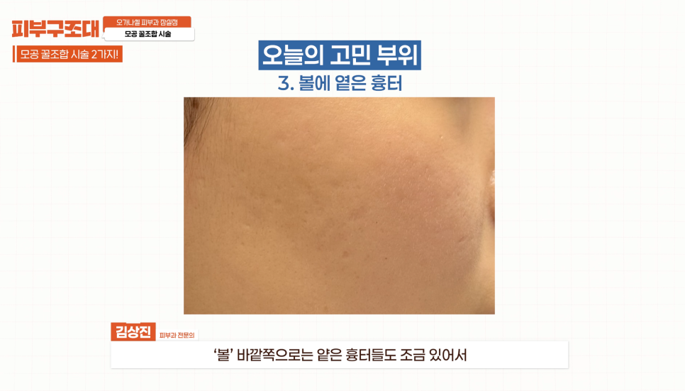 모공 포텐자, 함께 받으면 좋은 잠실피부과 관리 1가지 관련 이미지 4