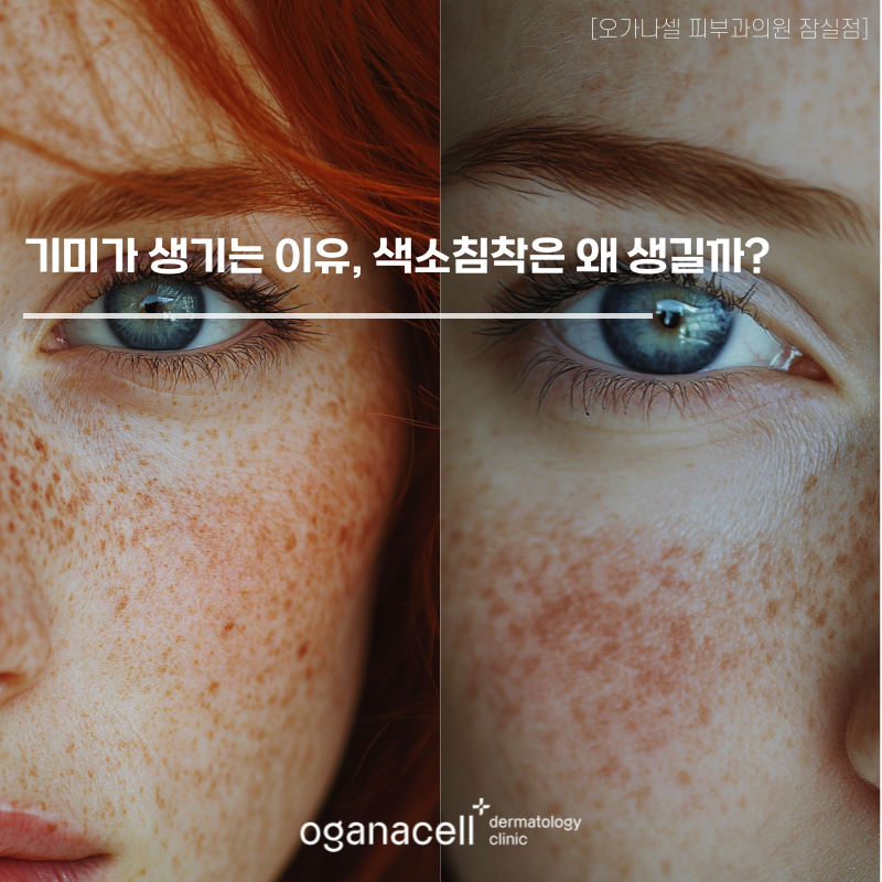 기미가 생기는 이유, 색소침착은 왜 생길까? 관련 이미지 1