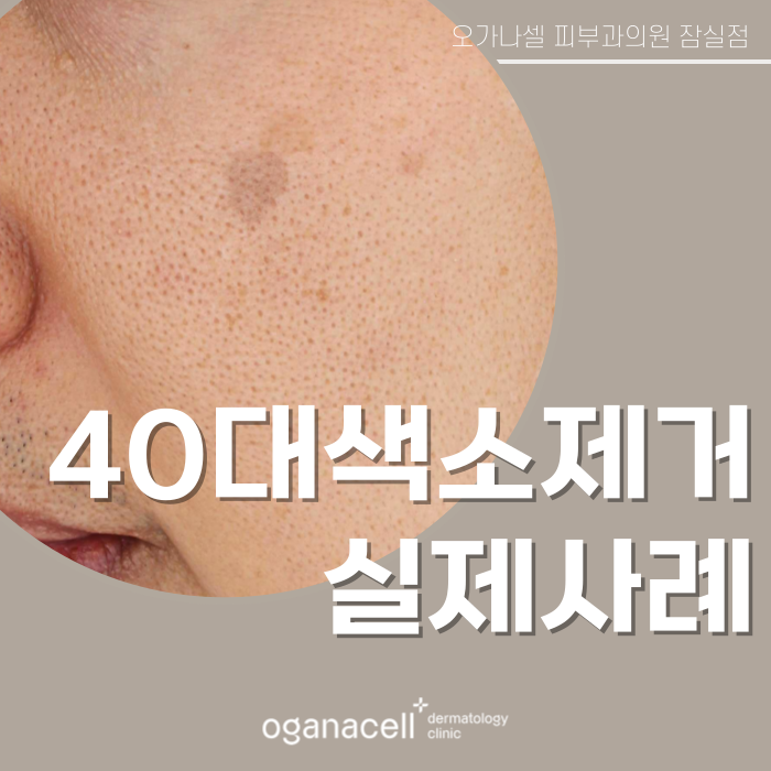40대색소제거 전후 비교 후기 관련 이미지 1