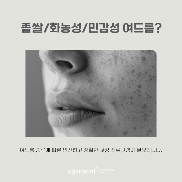 얼굴 트러블 원인 제거해서 해결해 주는 잠실피부과 관련 이미지 7