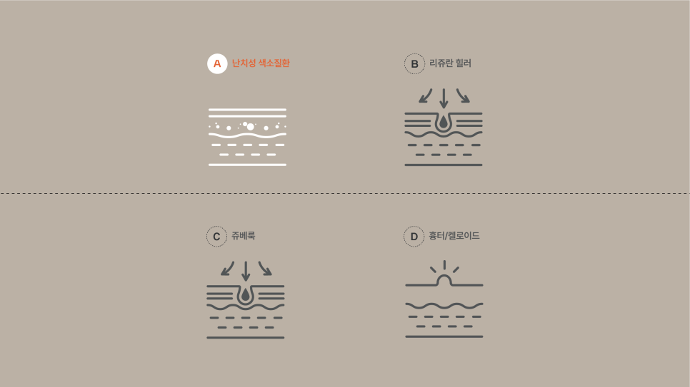 난치성색소질환 특징에 따른 맞춤 교정 관련 이미지 4