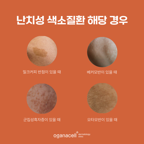난치성 색소 주의사항 알아야 하는 이유 관련 이미지 3
