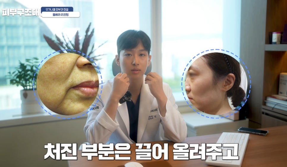 잠실울쎄라 부작용 볼패임을 피하려면? 관련 이미지 12