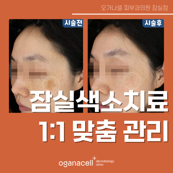 잠실색소제거 점 사마귀 검버섯 잡티 주근깨 맞춤 관리 관련 이미지 1