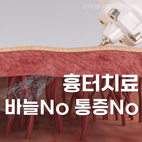 흉터 안 아프게 없애는 법 관련 이미지 1