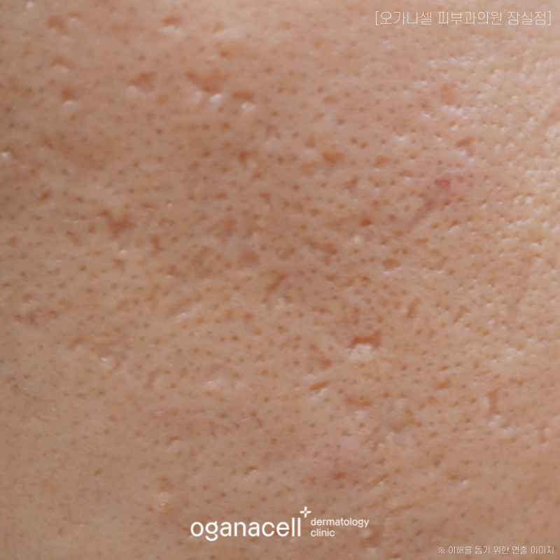 How to Care for Acne Scars, Step by Step Without Irritation image 3