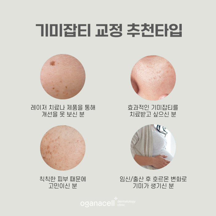 잠실역 피부과 임신출산 후 기미관리 관련 이미지 3