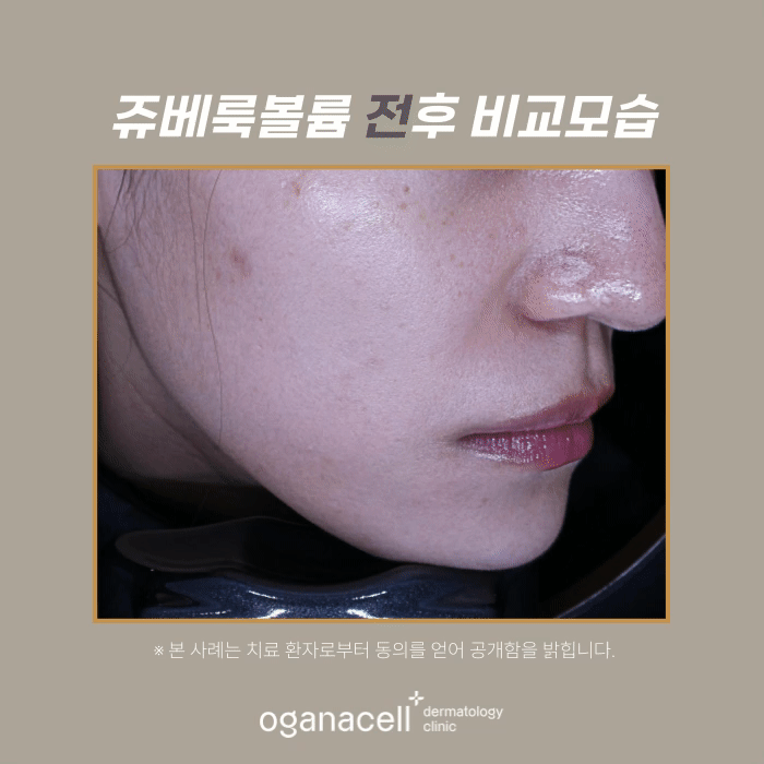 잠실쥬베룩볼륨 전후 비교 실제사례 관련 이미지 4