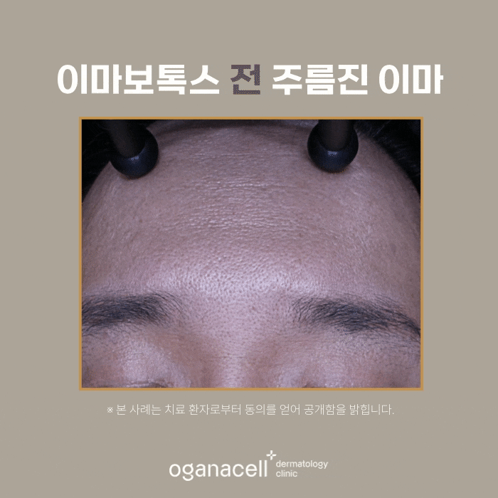 잠실 이마보톡스 전후 비교 후기 관련 이미지 4