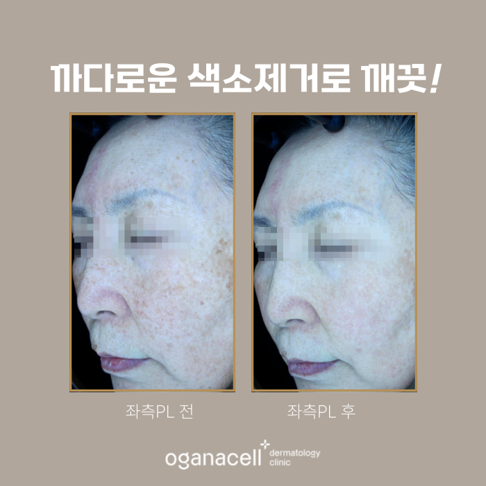 60대 기미 제거 전후 비교 실제사례 관련 이미지 4