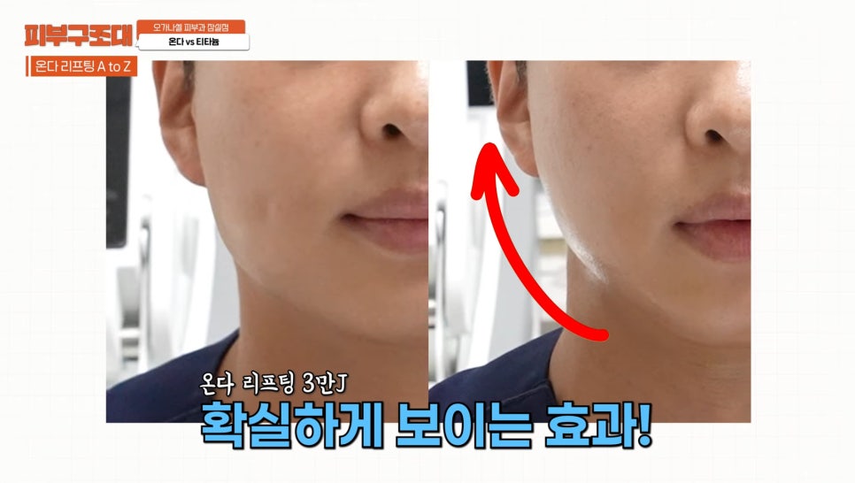 잠실 온다 티타늄 리프팅 피부과, 즉각적인 효과를 주는 건? 관련 이미지 7