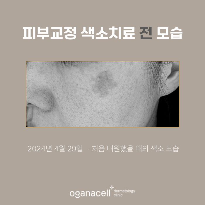잠실피부과 색소 교정 실제사례 전후 비교 관련 이미지 2