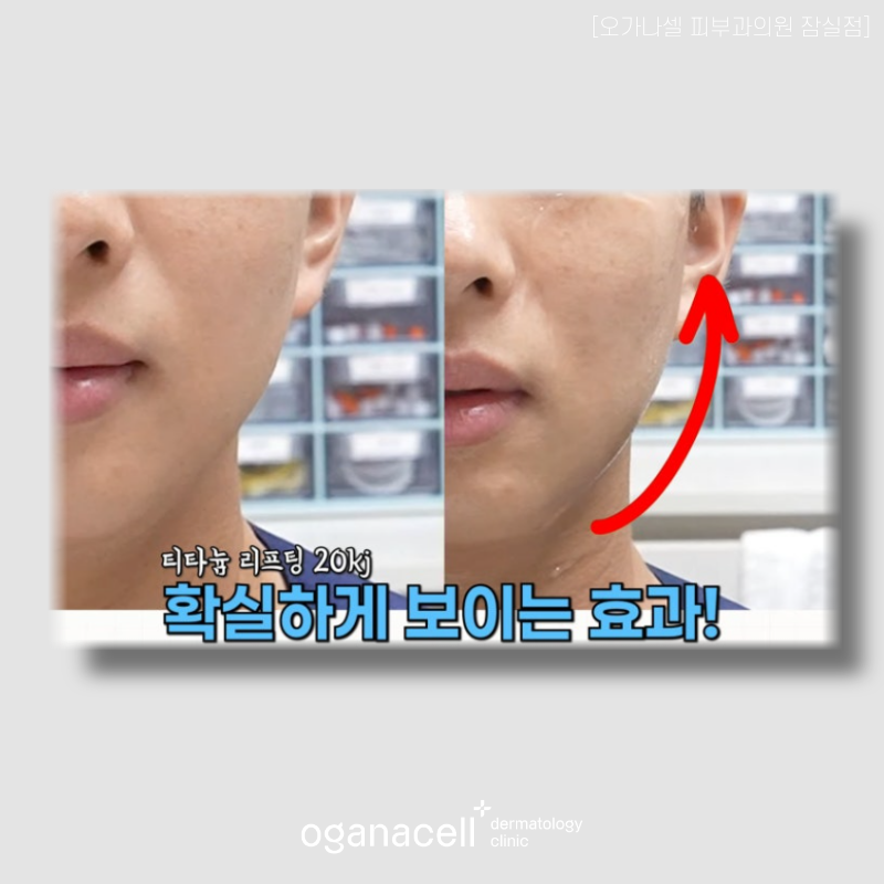잠실역피부과 통증 부담 적은 티타늄리프팅 정리 관련 이미지 5