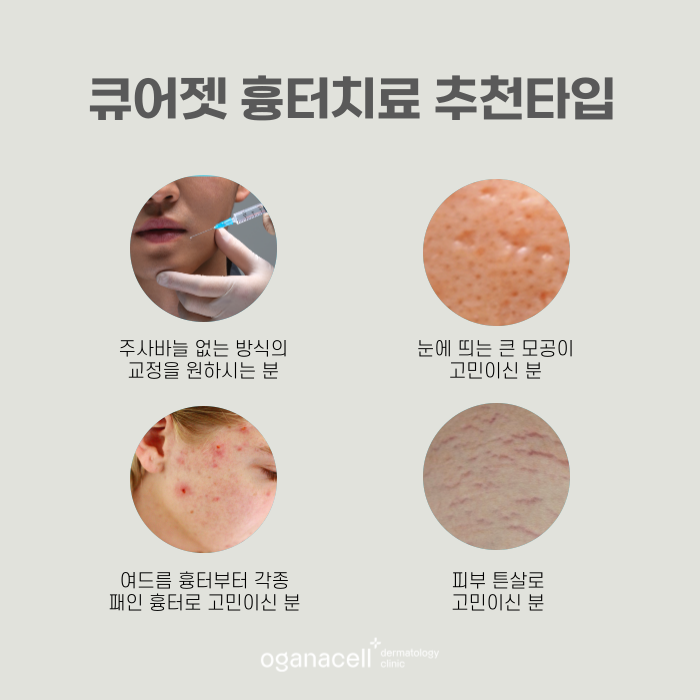 큐어젯 흉터 잠실역에 잘하는 곳 관련 이미지 4