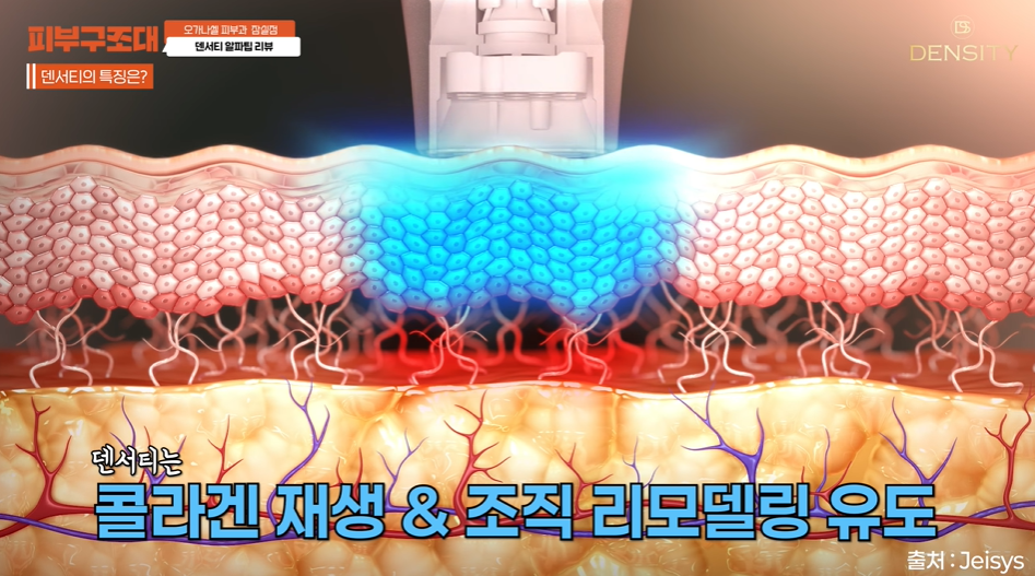 Jamsil Dermatology Clinic: Low-Pain Lifting—Density vs. Thermage image 2