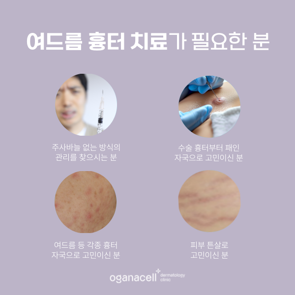 잠실여드름피부과 바늘없는 큐어젯 흉터 관리 방법 관련 이미지 3