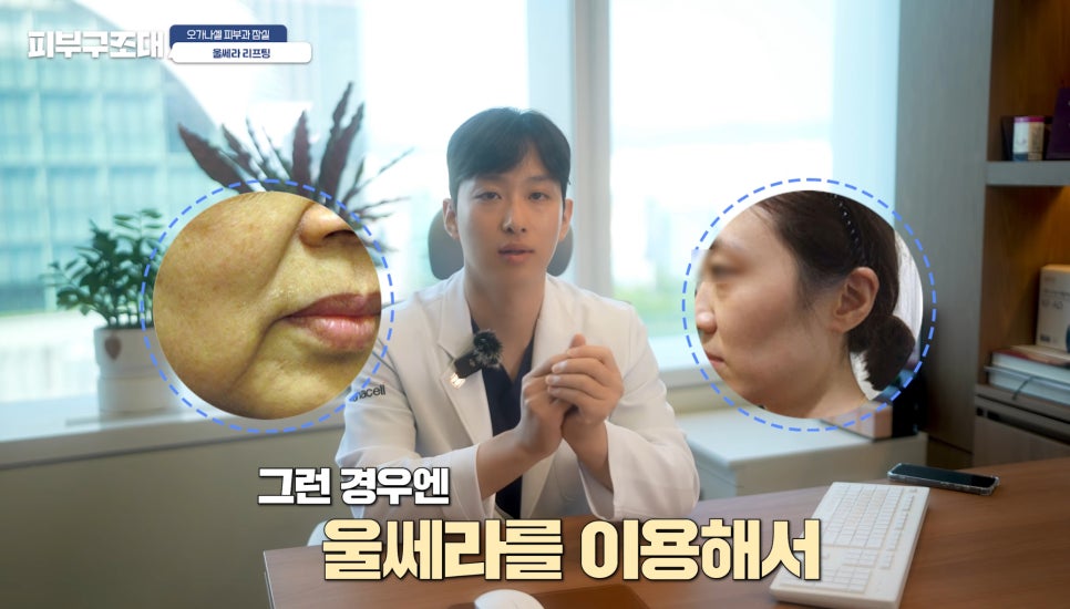 잠실울쎄라 부작용 볼패임을 피하려면? 관련 이미지 11