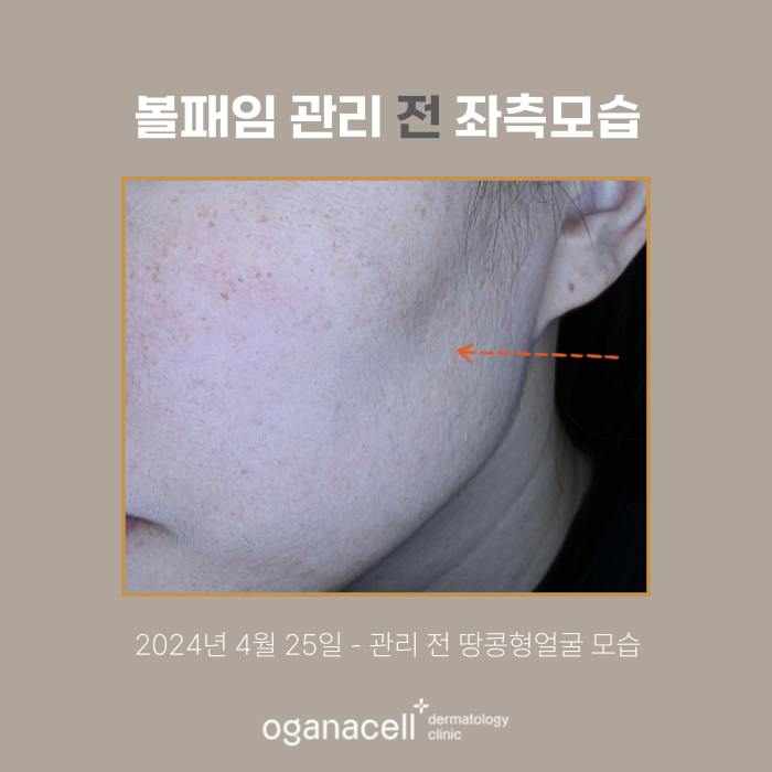 잠실역 스컬트라 관리 실제사례 후기 관련 이미지 4