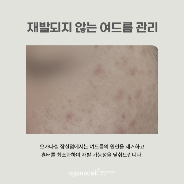 잠실여드름피부과 재발 가능성 낮추는 팁 관련 이미지 4