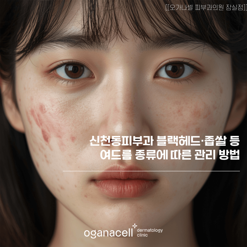 신청동피부과 블랙헤드&middot;좁쌀 등 여드름 종류에 따른 관리 방법 관련 이미지 1