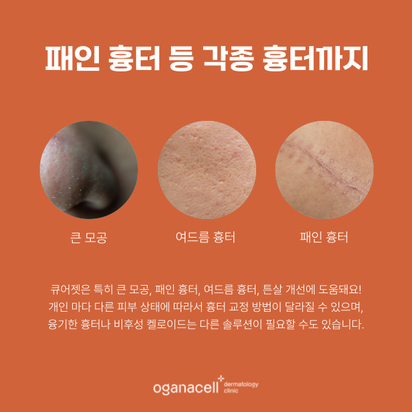 잠실 여드름흉터 제거하는 방법 관련 이미지 5