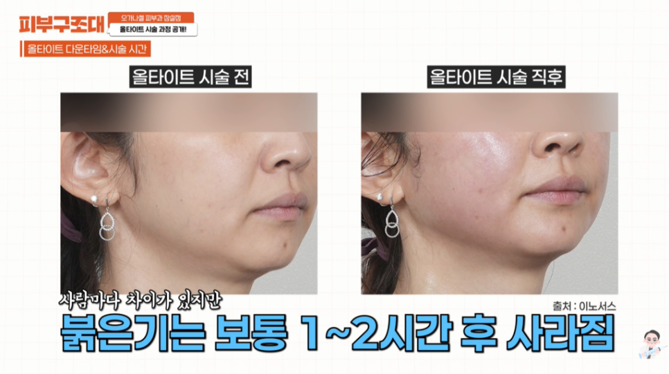 Dermatology Clinic Near Jamsil Station Exit 1: AllTight Lifting Review Revealed image 5