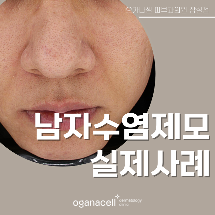 남자수염제모 전후 비교 실제사례 관련 이미지 1