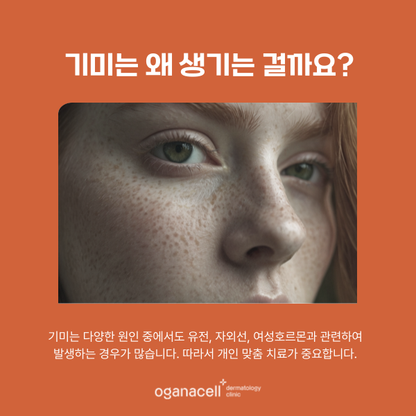 기미 고민 재발방지관리 중요합니다 관련 이미지 4