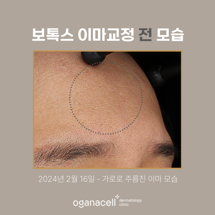 잠실 이마보톡스 전후 비교 후기 관련 이미지 2