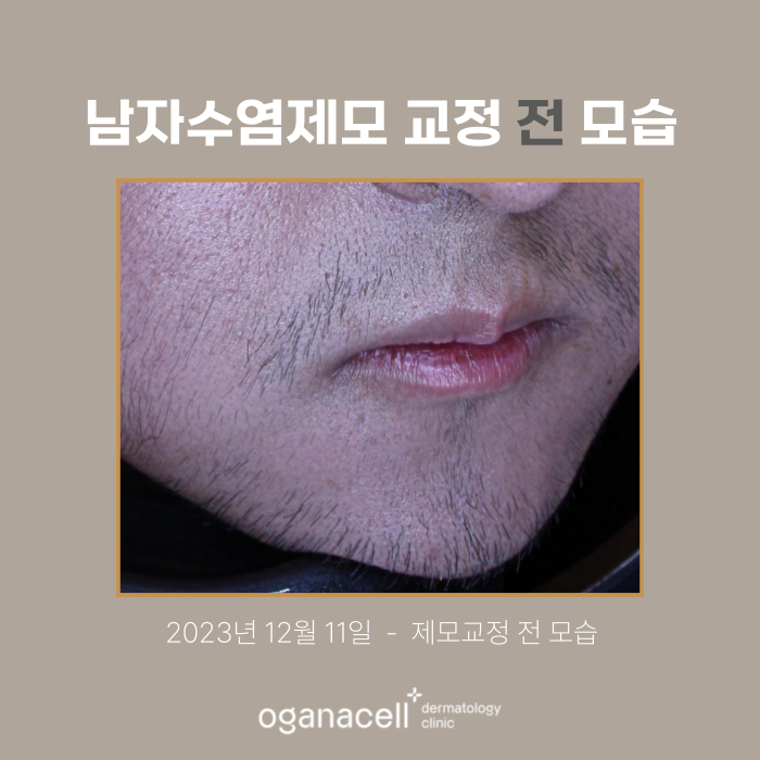 잠실 남자수염제모 피부과 관리 전후 비교 관련 이미지 2