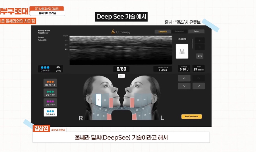 잠실 울쎄라피 프라임 피부과 효과 보는 방법 관련 이미지 2