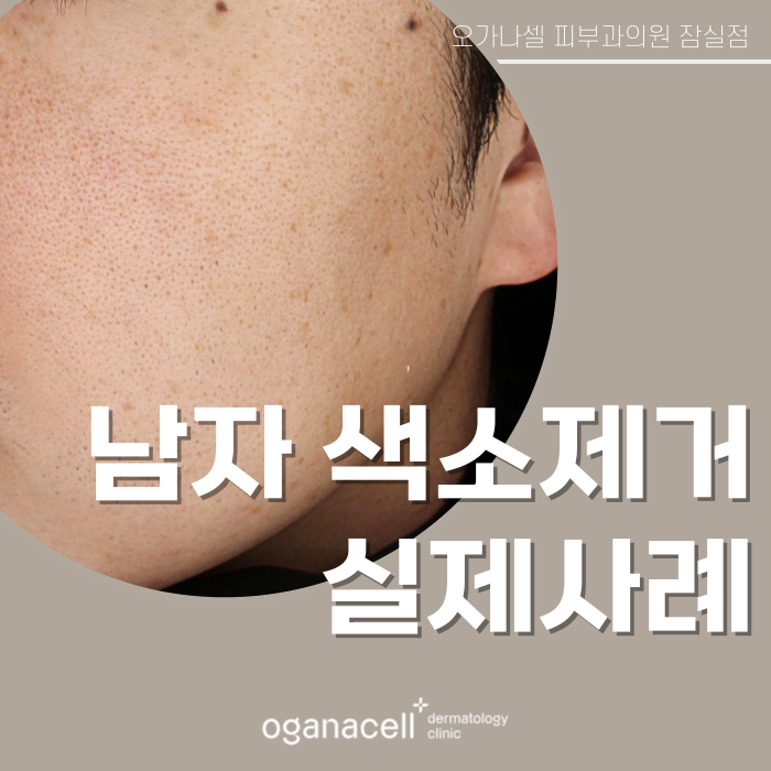 잠실피부과 기미 색소 제거 실제 후기 관련 이미지 1