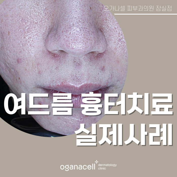여드름 흉터 교정 20대 전후 비교 실제사례 관련 이미지 1