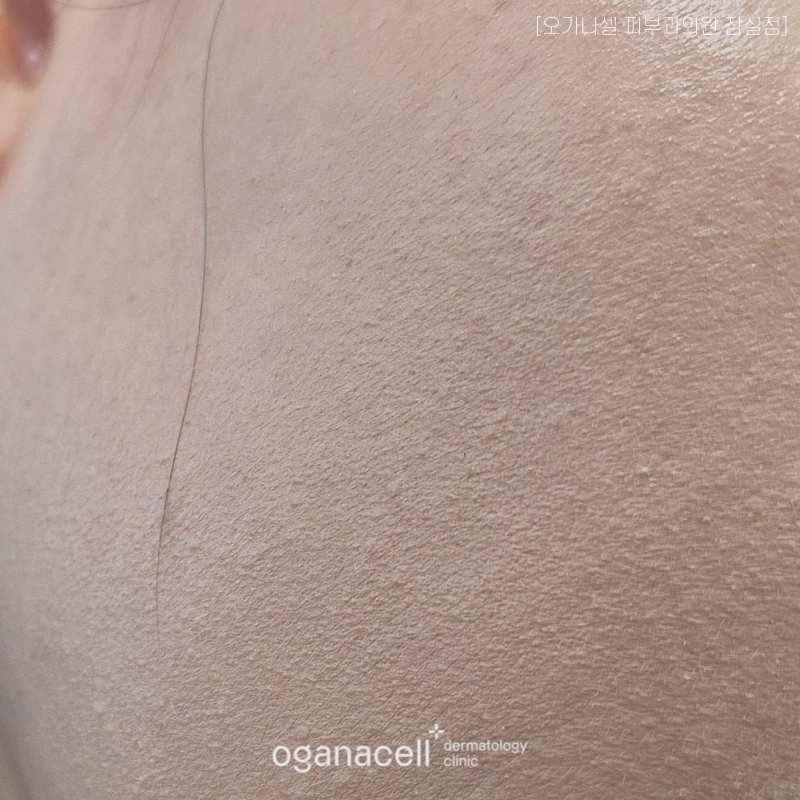 잠실 리쥬란 엠보 손주사없이 하는 방법이 있다? 관련 이미지 3
