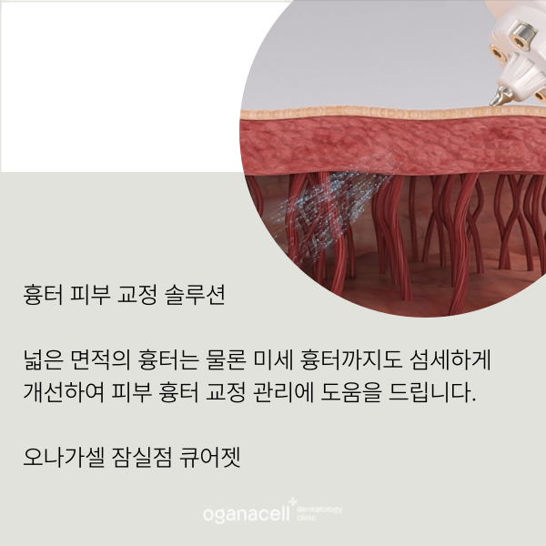 롯데월드타워피부과 흉터 관리 잘하는 곳 관련 이미지 8