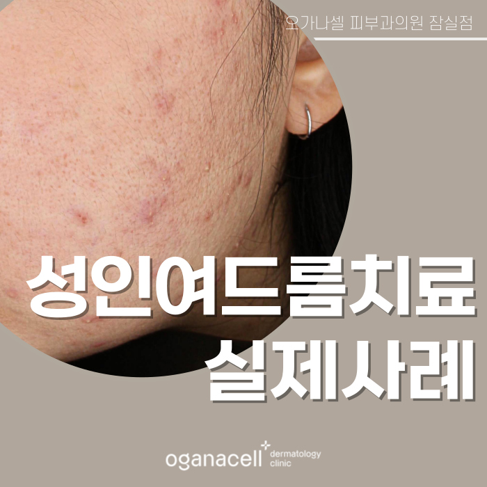 성인여드름 제거 후기 전후 비교 실제사례 관련 이미지 1