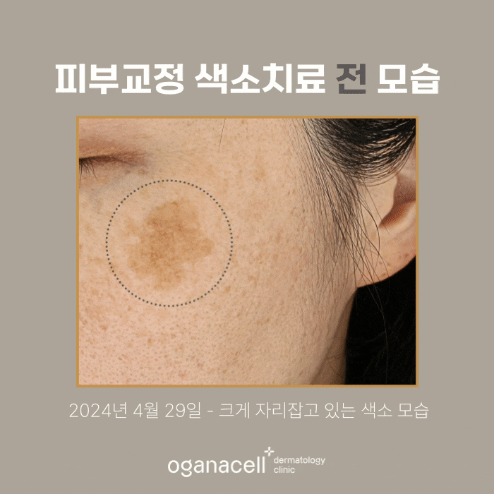 잠실역색소치료 색소제거 전후 비교 후기 관련 이미지 4