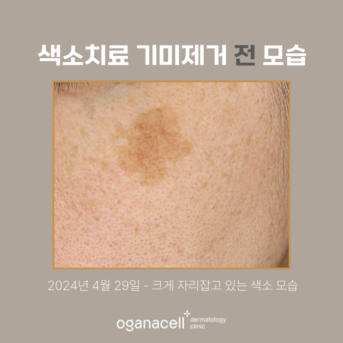 잠실역색소치료 색소제거 전후 비교 후기 관련 이미지 2