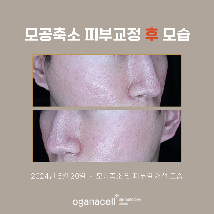 송파구모공피부과 관리 전후 실제사례 후기 관련 이미지 3