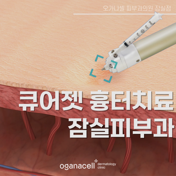 잠실새내 흉터치료 큐어젯 하는 곳 관련 이미지 1