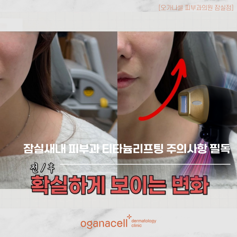잠실새내 피부과 티타늄리프팅 주의사항 필독! 관련 이미지 1