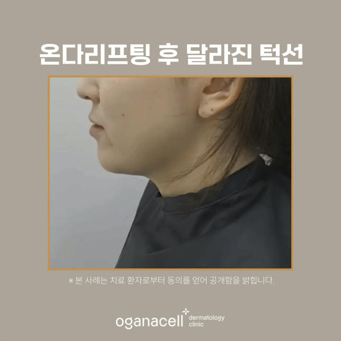 잠실 온다리프팅 관리 전후 비교 실제사례 관련 이미지 4