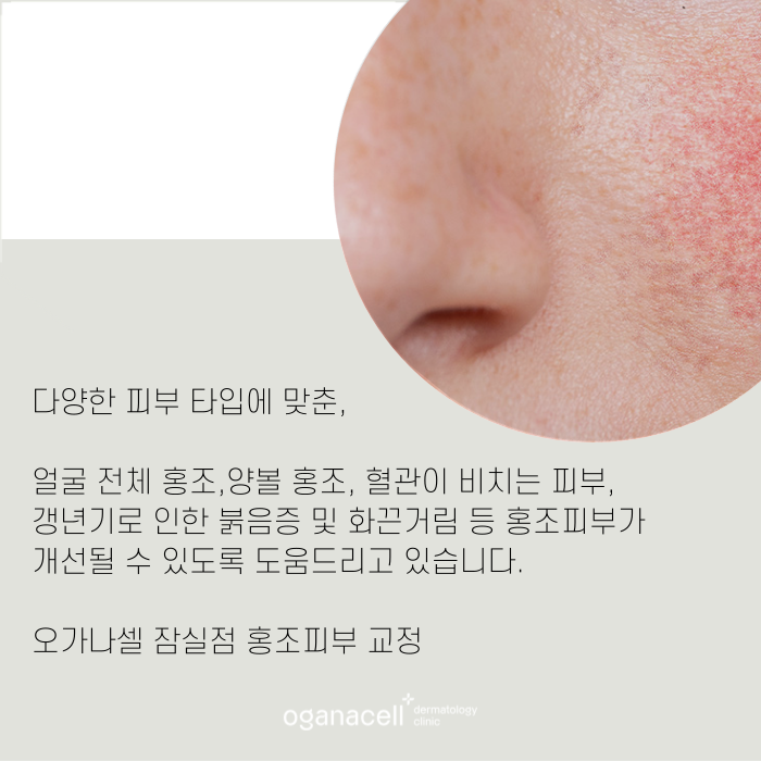 잠실 안면홍조 유형과 원인에 따라 교정해 주는 곳 관련 이미지 9